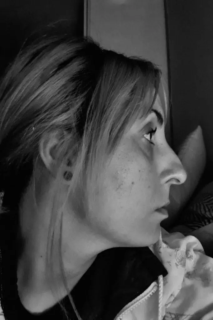  Antes de una rinoplastia en Coruña – casos reales