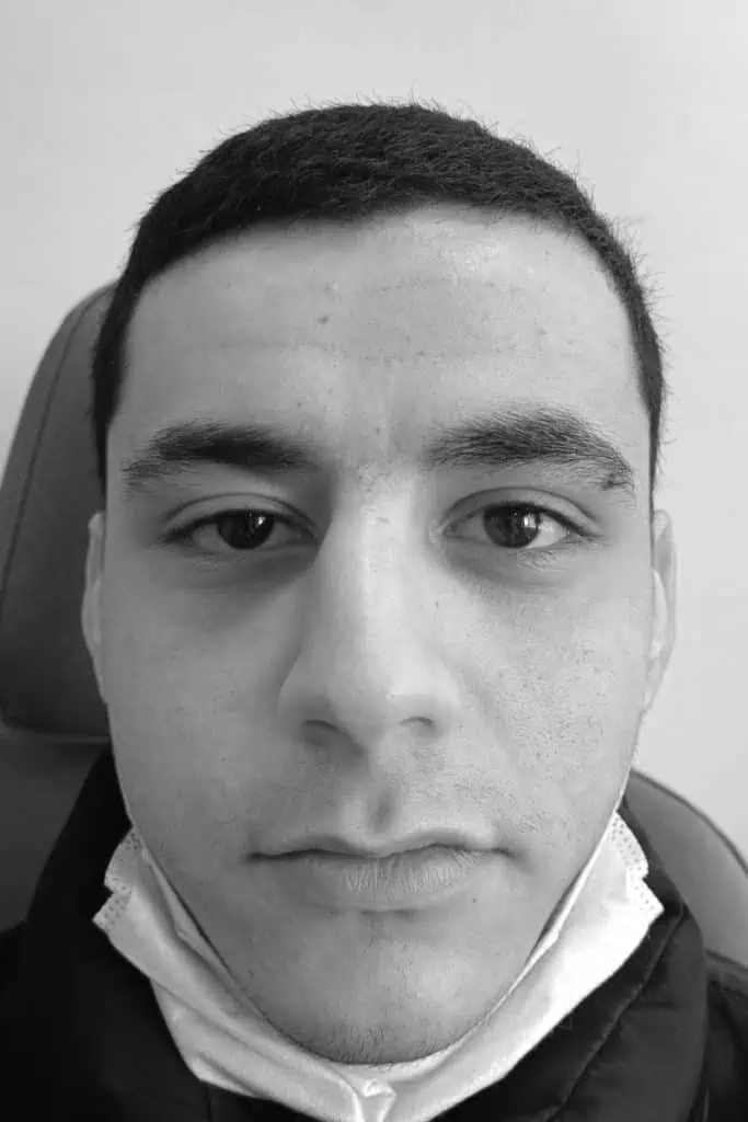 Antes de una rinoplastia en Coruña – casos reales