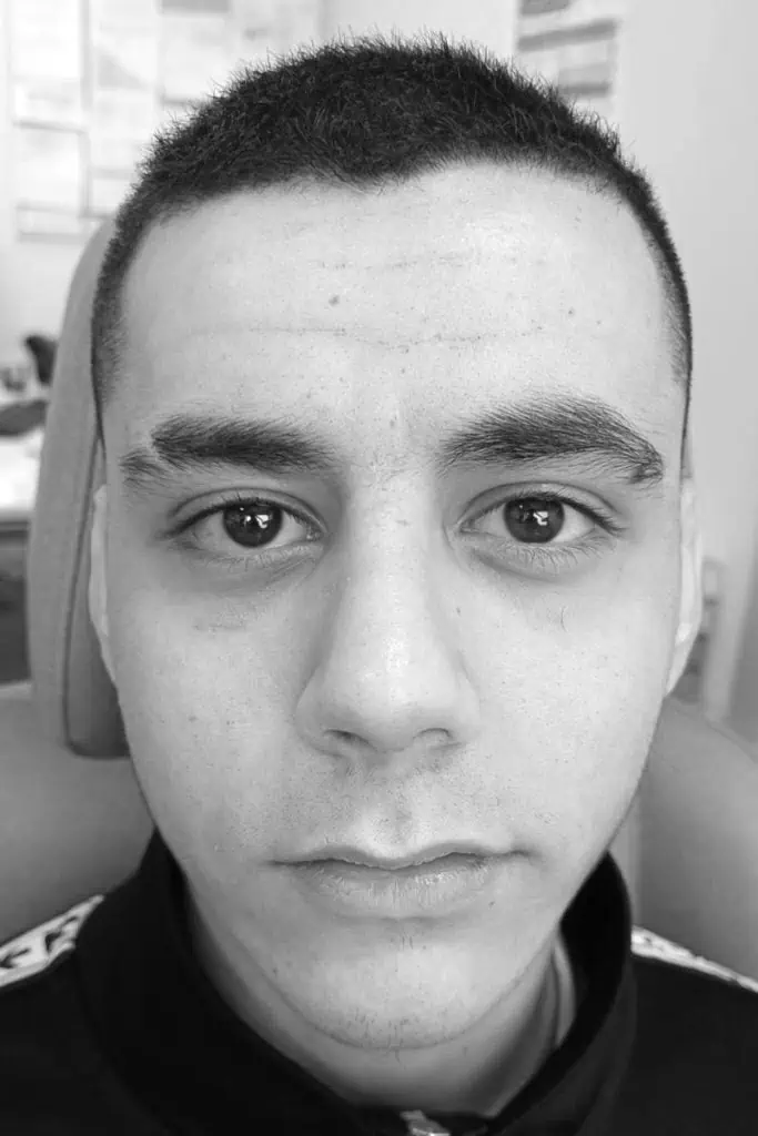 Después de una rinoplastia en Coruña – casos reales